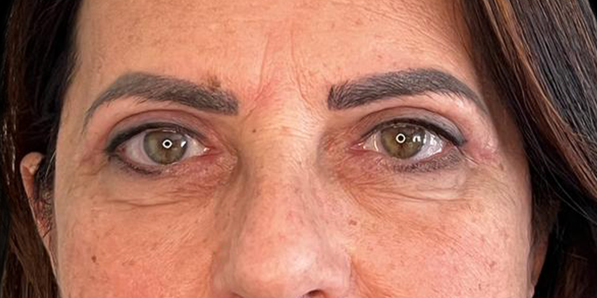 Blefaroplastica POST