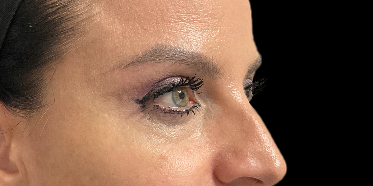 blefaroplastica 2 POST