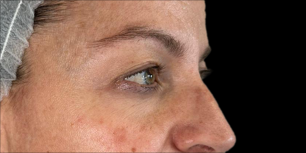 blefaroplastica 2 PRE