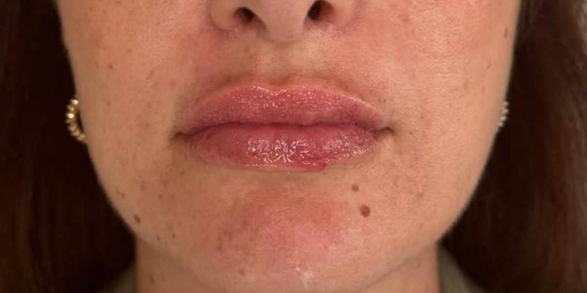 filler labbra 1 POST