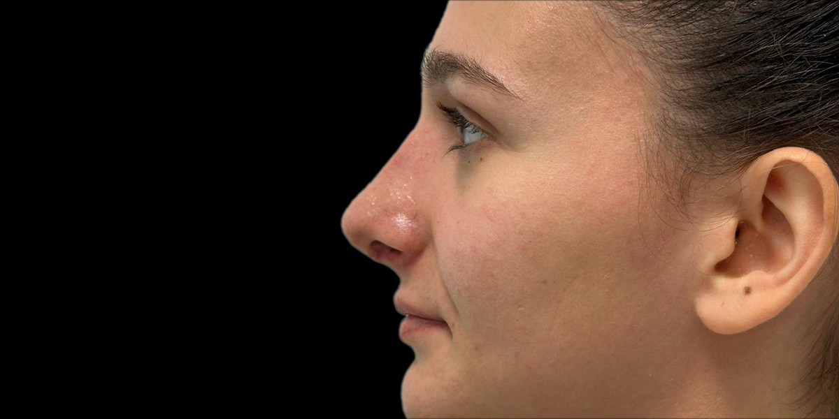 rinoplastica 2 POST