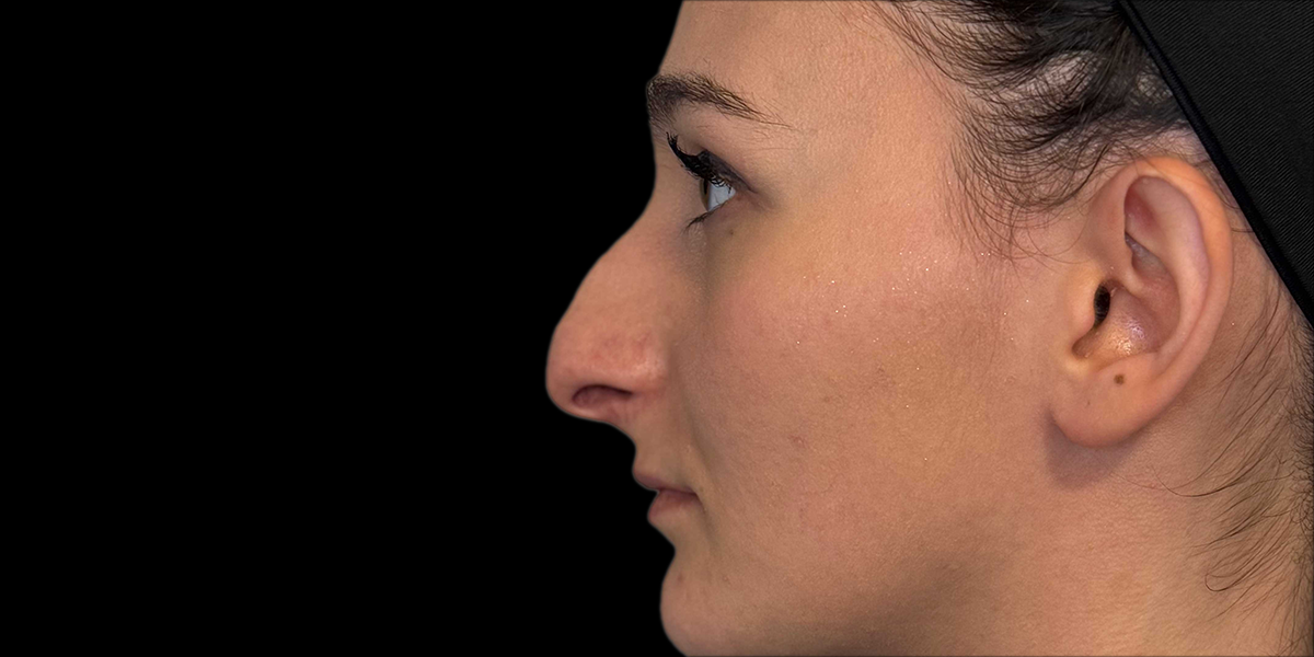 rinoplastica 2 PRE